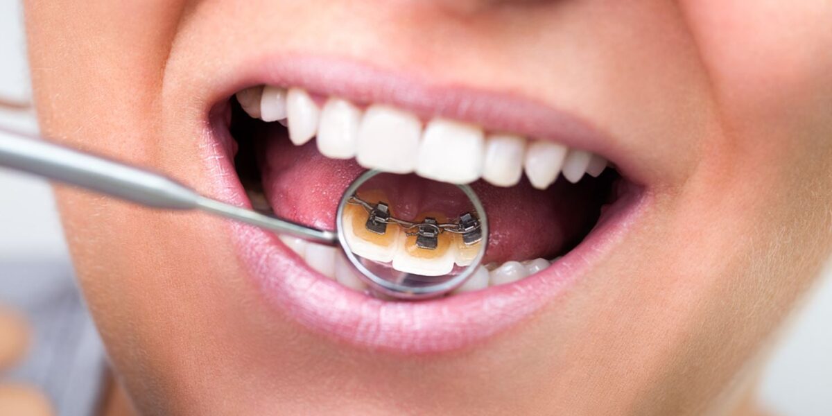 What you need to know about lingual braces